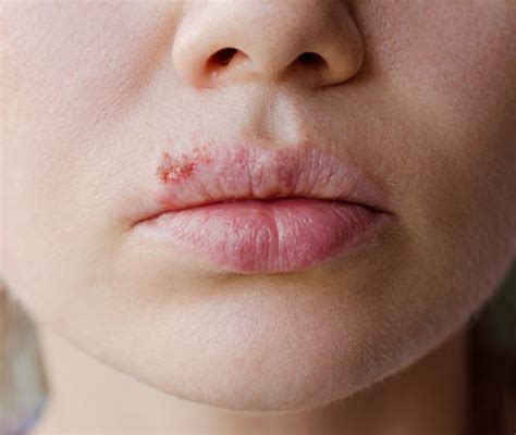 herpes labiale quando preoccuparsi